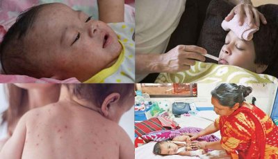 ৩০ উপজেলায় শুরু হচ্ছে হামের বিশেষ টিকাদান কর্মসূচী: 'আতঙ্কিত হবেন না' বললেন স্বাস্থ্যমন্ত্রী