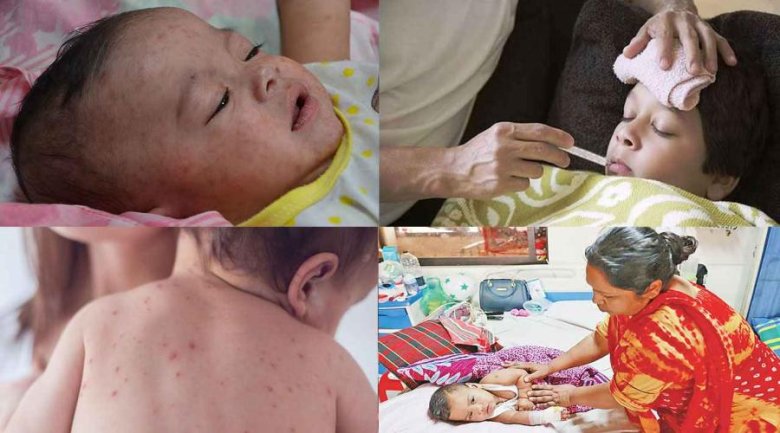 ৩০ উপজেলায় শুরু হচ্ছে হামের বিশেষ টিকাদান কর্মসূচী: 'আতঙ্কিত হবেন না' বললেন স্বাস্থ্যমন্ত্রী